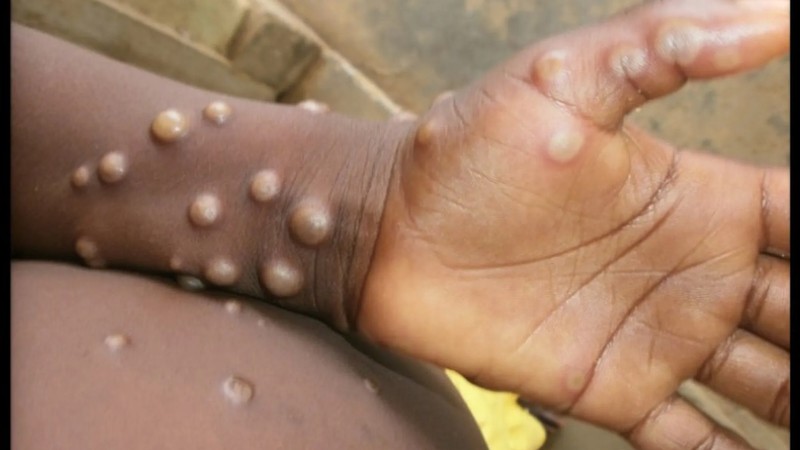 MPOX- WHAT YOU NEED TO KNOW FROM ICNC